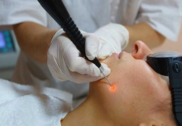 Удаление кожных новообразований лазером